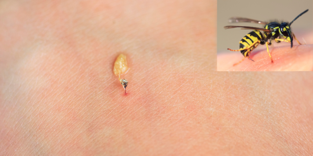 A Stranger Being Stung By a Wasp