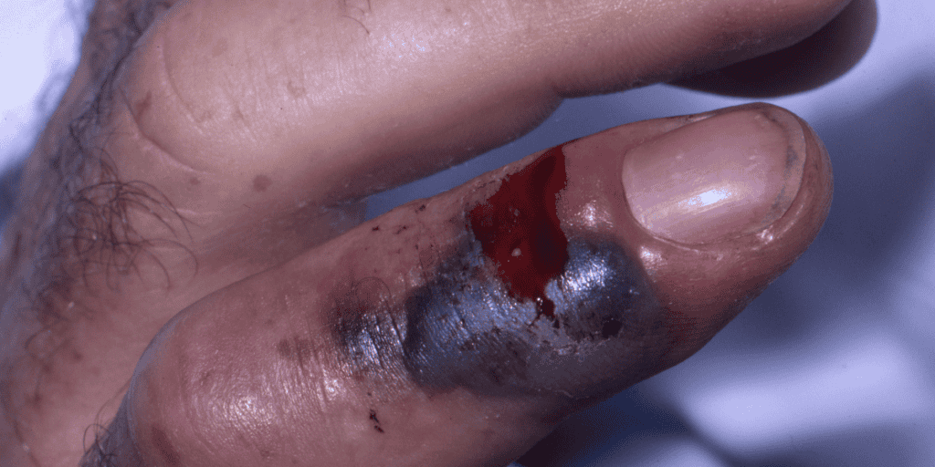 Dream About Multiple Snake Bites